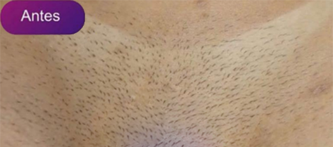 Antes e depois - Depilação a laser GIO
