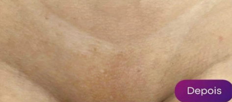 Antes e depois - Depilação a laser GIO