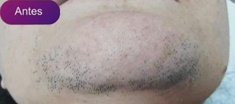 Antes e depois - Depilação a laser GIO