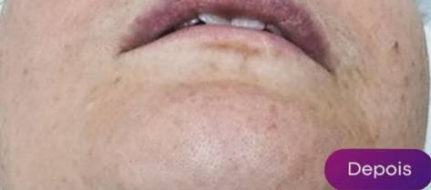 Antes e depois - Depilação a laser GIO