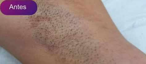 Antes e depois - Depilação a laser GIO