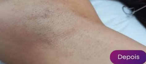 Antes e depois - Depilação a laser GIO