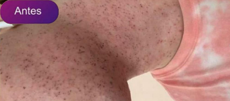 Antes e depois - Depilação a laser GIO