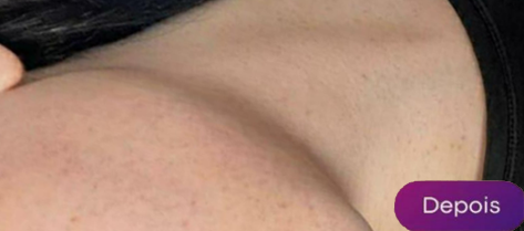 Antes e depois - Depilação a laser GIO