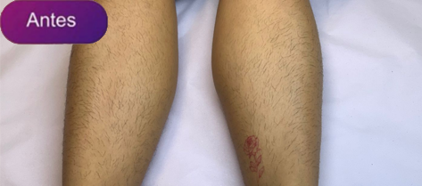 Antes e depois - Depilação a laser GIO