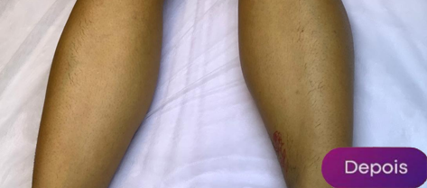 Antes e depois - Depilação a laser GIO